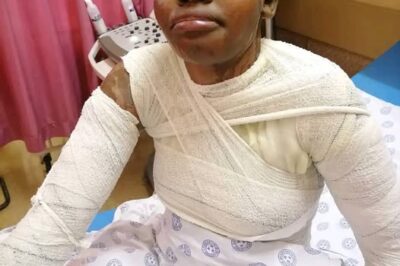 Tragic Acid Attack Leaves Limpopo Woman Scarred for Life in Love Triangle Drama